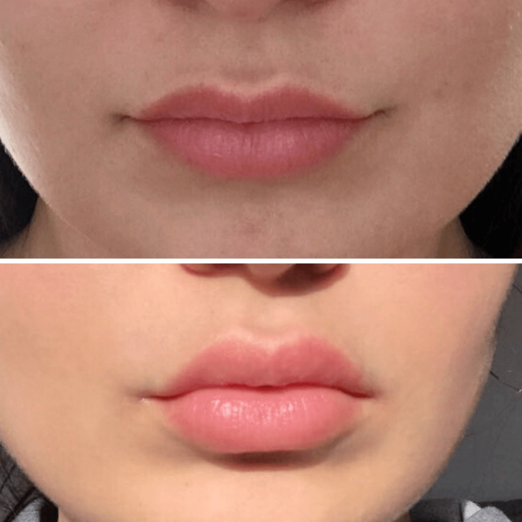 Dreaming of fuller, natural-looking lips? Explore how Botox Lippen treatments offer a subtle alternative to traditional lip injections for perfect facial harmony.