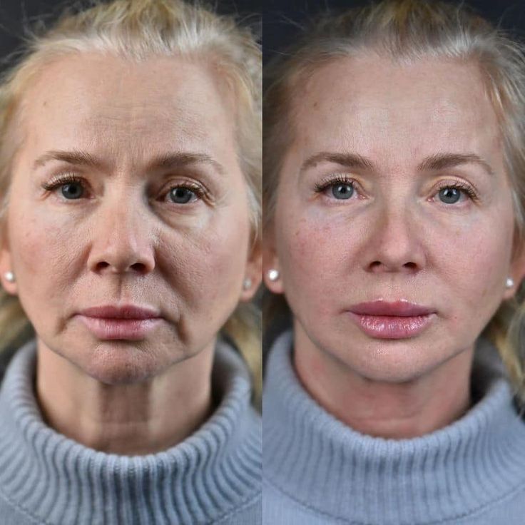 Marionette Lines Treatment