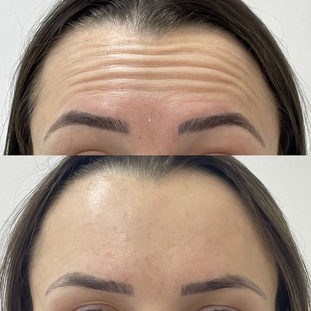 Botox Spätfolgen Explained So You Can Decide Whether to Buy