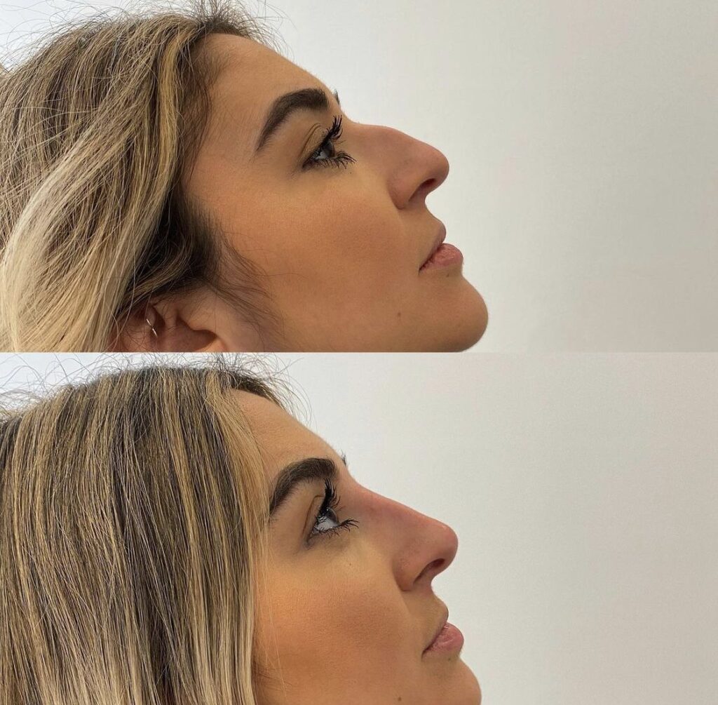 Non Surgical Nose Job Before and After Results